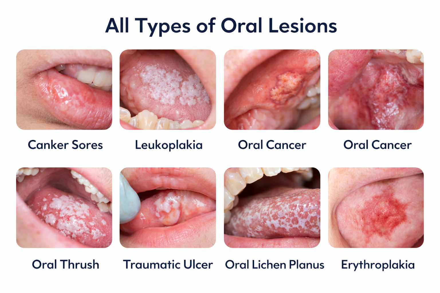 All Types of Oral Lesions